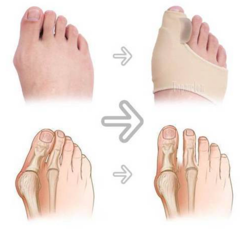 Correcteur orthopédique pour Hallux Valgus (Oignon)