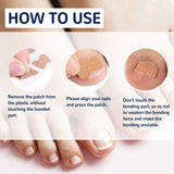 50x Patchs correcteurs d'ongles incarnés