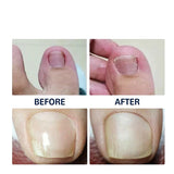 Patchs correcteur d'ongles incarnés